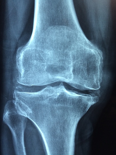 5. Osteoporóza a‌ výživa: Jaká⁣ strava ⁣podporuje zdravé ⁢kosti