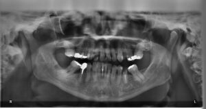 Po vytržení zubu: Babské rady pro rychlé zotavení